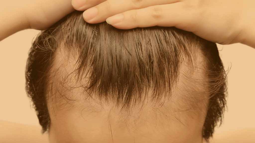 Qu’est-ce que l’alopécie&nbsp;?